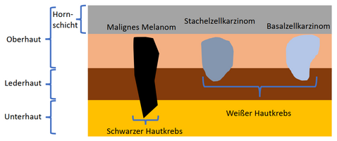 Stadien von Hautkrebs (Malignes Melanom & Karzinom)